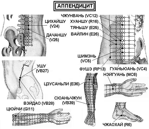 Точки аппендицита