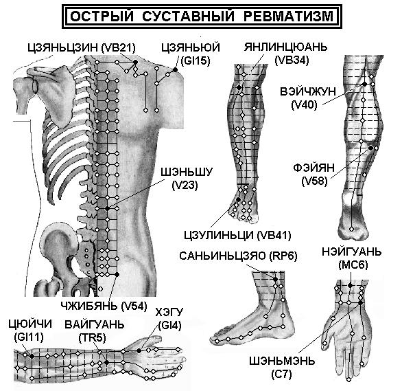 Dupuytren's: Dupuytren Distal Interphalangeal Joint Needle Fasciotomy
